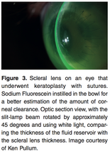 Load image into Gallery viewer, Chapter 1: Vital Stain In Scleral lens Practice (E-Book)