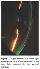 Load image into Gallery viewer, Chapter 2: Scleral Shape Assessment Using Slit Lamp and Diagnostic Scleral Lenses (E-Book)