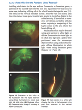 Load image into Gallery viewer, Chapter 2: Scleral Shape Assessment Using Slit Lamp and Diagnostic Scleral Lenses (E-Book)
