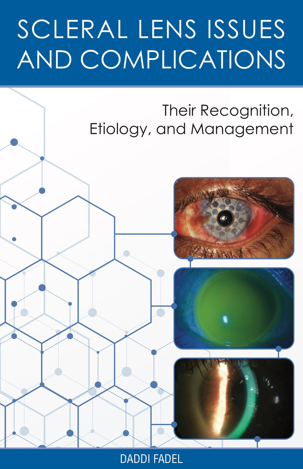 Scleral Lens Issues and Complications - Complete E-Book