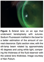 Load image into Gallery viewer, Chapter 1: Vital Stain In Scleral lens Practice (E-Book)
