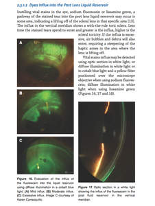 Chapter 2: Scleral Shape Assessment Using Slit Lamp and Diagnostic Scleral Lenses (E-Book)